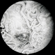 Retinal Av malformation FA 3